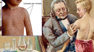 Edward Jenner and the smallpox vaccine